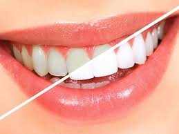 Сучасні методики відбілювання зубів