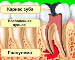 Гранульома зуба. Причини виникнення та методи лікування