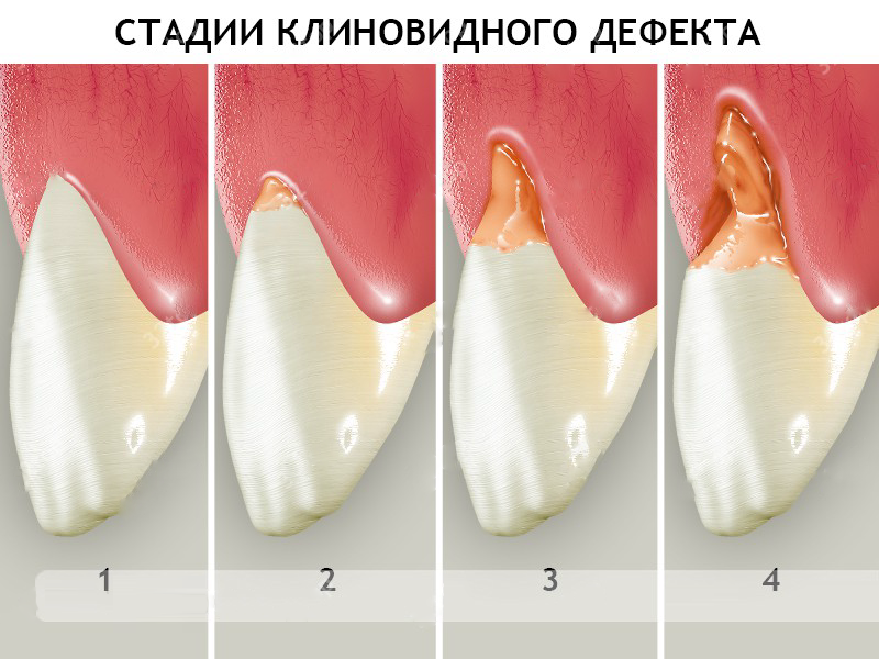 Причини виникнення клиновидних дефектів зубів та методи їх корекції